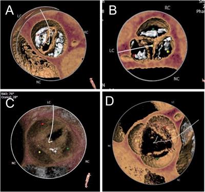 Lower incidence of new-onset severe conduction disturbances after transcatheter aortic valve implantation with bicuspid aortic valve in patients with no baseline conduction abnormality: a cross-sectional investigation in a single center in China